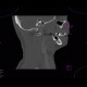 Follicular cyst: CT - Computed tomography